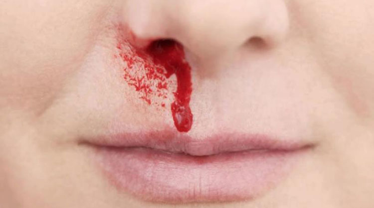 14岁孩子流鼻血是什么原因引起的