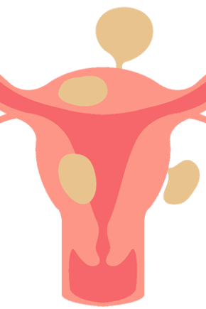 子宫肌瘤可以性生活吗对肌瘤有影响吗